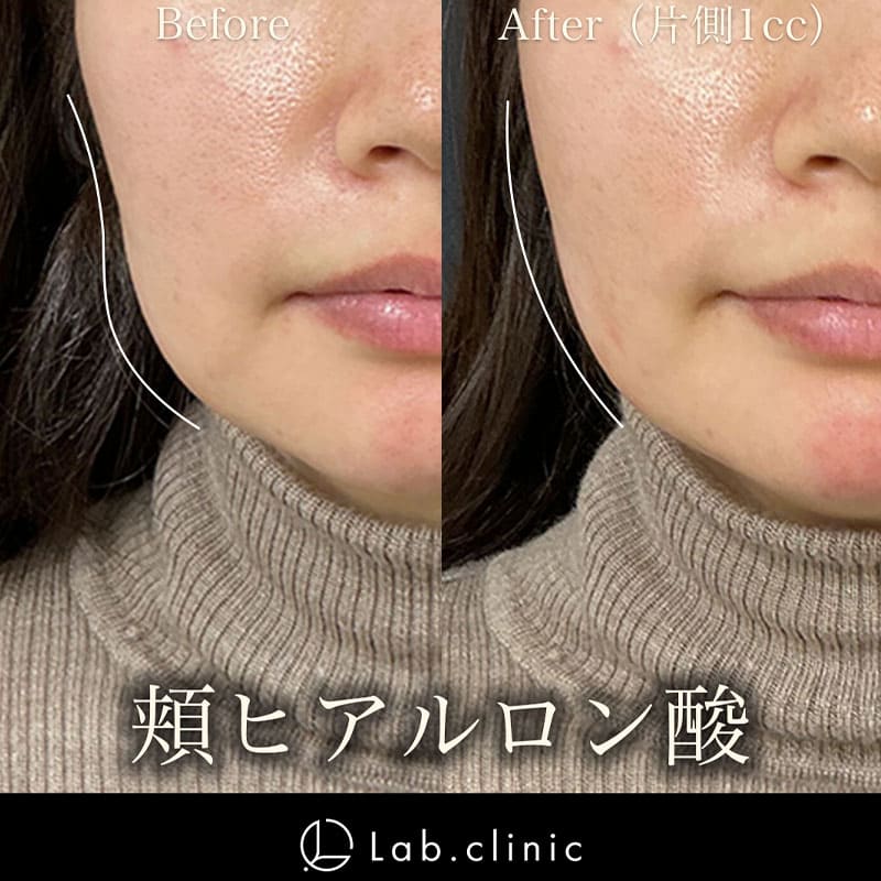 症例写真_頬ヒアルロン酸