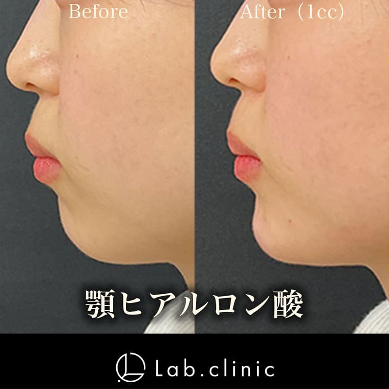 症例写真_顎ヒアルロン酸