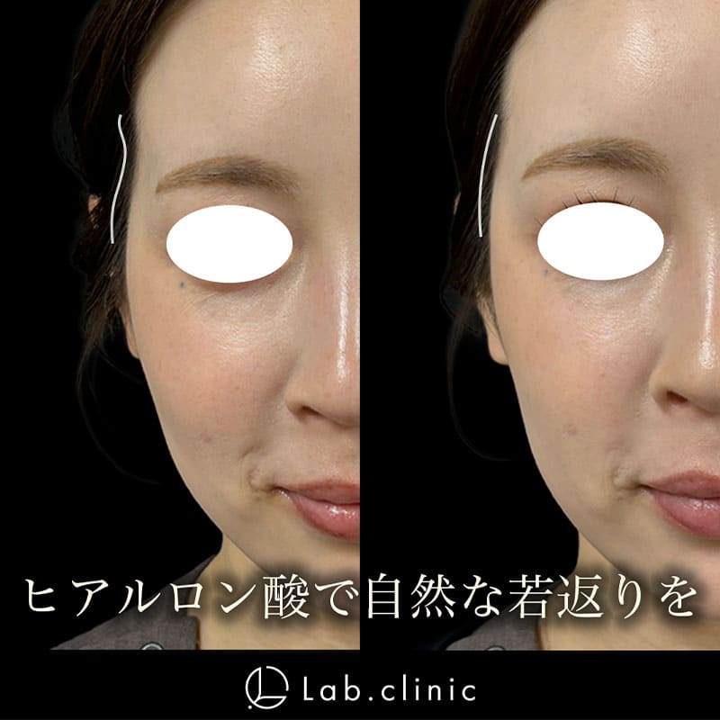 症例写真_ヒアルロン酸
