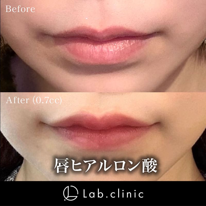 症例写真_唇ヒアルロン酸