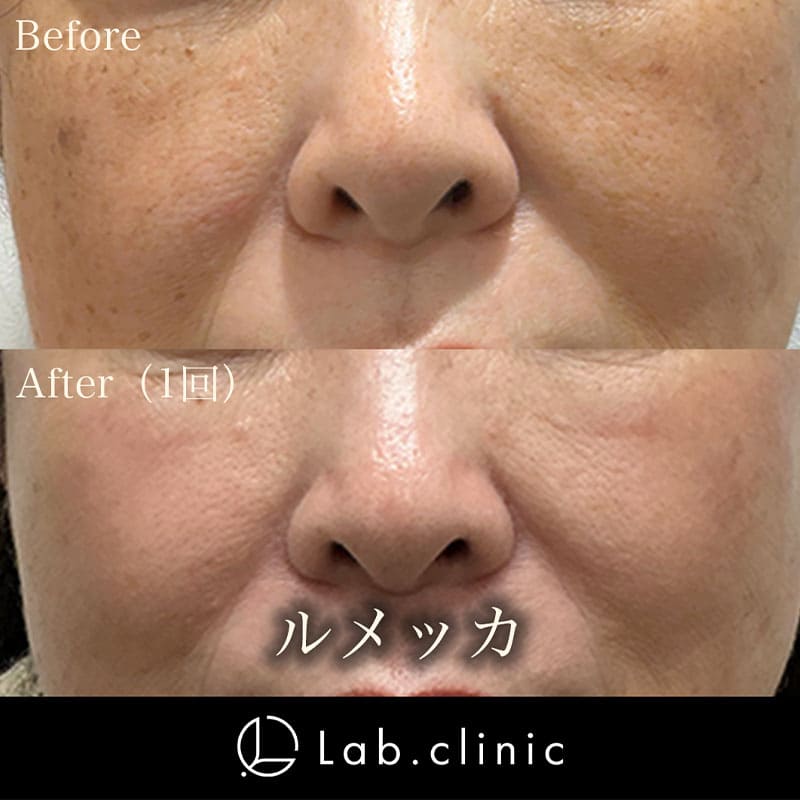 症例写真_ルメッカ