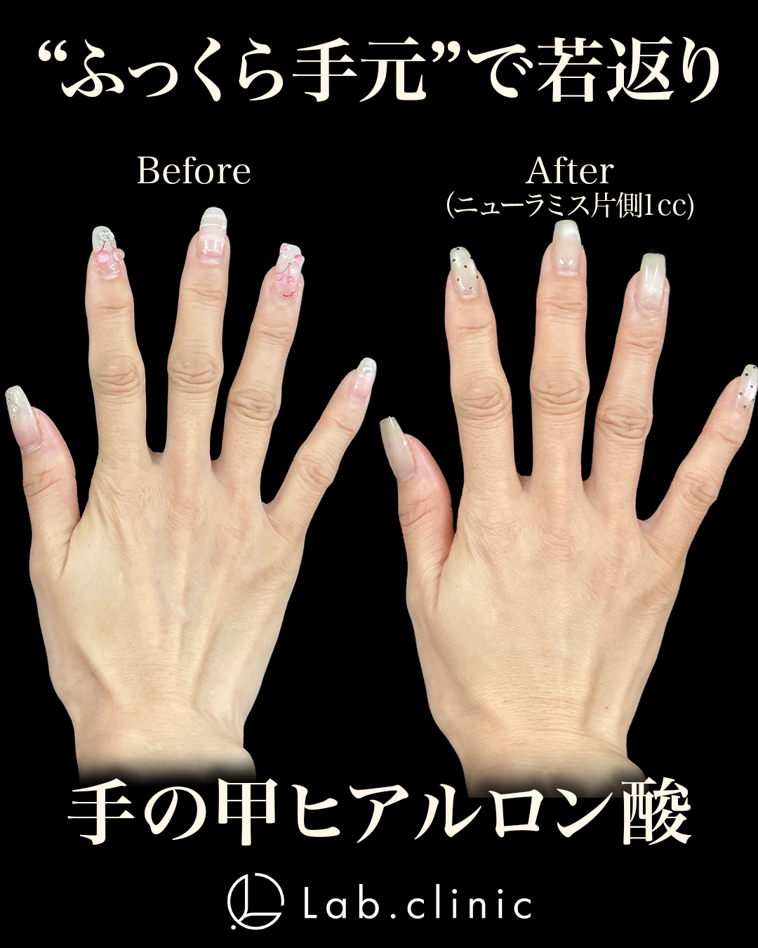 手の甲のヒアルロン酸注入の治療前後写真。ニューラミスリドカインを片側1cc、両手合計2cc使用。左が治療前、右が施術1週間後。