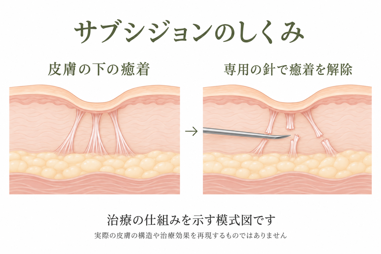 皮膚の下の癒着と、専用の針でその癒着を解除する仕組みを示す模式図